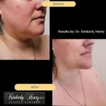 Best Breast Augmentation Roseville Best Breast Augmentation Roseville